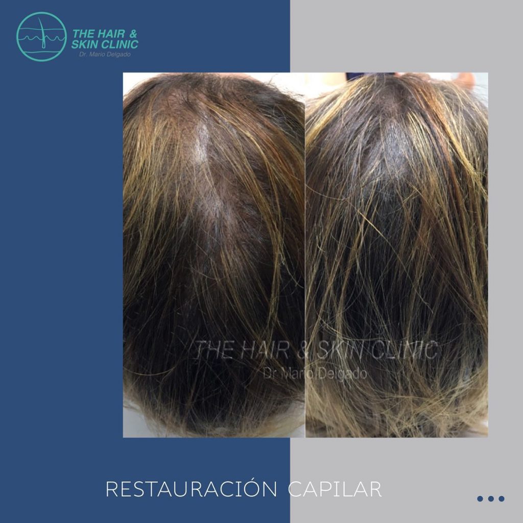 restauracion capilar